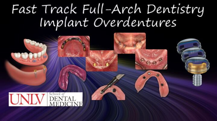 Fast Track Full-Arch Dentistry - Implant Overdentures