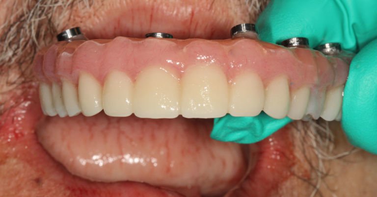 Double Arch Allon4 Immediate Prosthesis with exocad Plovdiv – Milled Prosthesis!