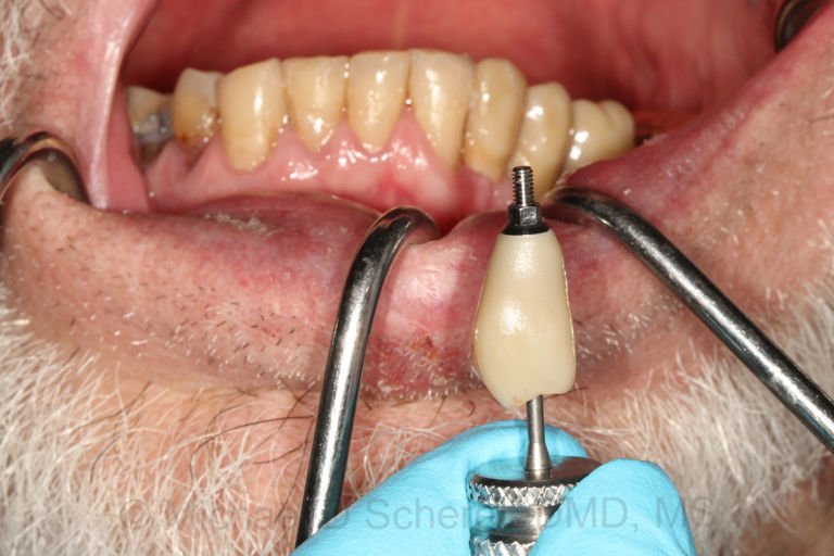 Super Fast In-Office Screw-Retained Zirconia Crowns in HOURS (Not Weeks)!