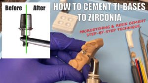 How to Cement Ti-Bases