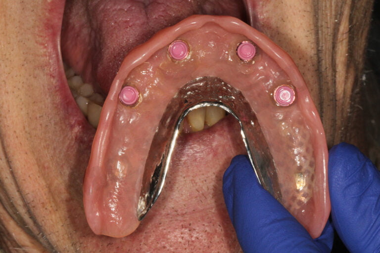 Implant Overdentures: To Frame or Not To Frame? “That is The Question!”