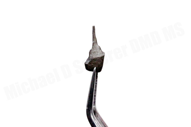 Digital Cast Post & Core – Hybrid Intraoral Scan and PVS Technique