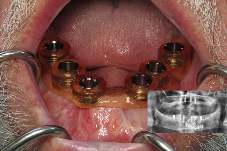 Case Report: Guided Surgery Technique to Make a Challenging Edentulous Case Predictable