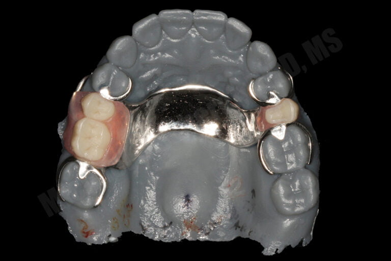 Working with 3D Printing Model to Fabricate Metal CoCr RPD Castings
