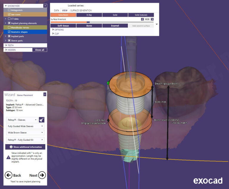 Case Selection & Computerized Guided Implant Surgery