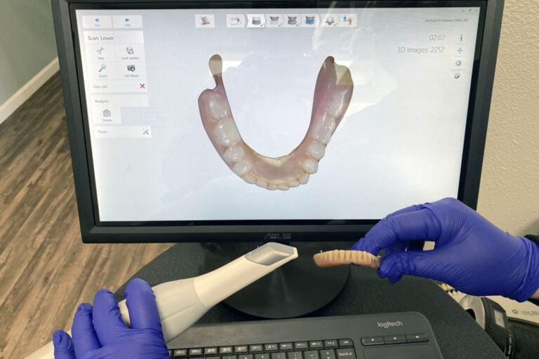 3Shape Trios Scan of 52-Year Old Denture