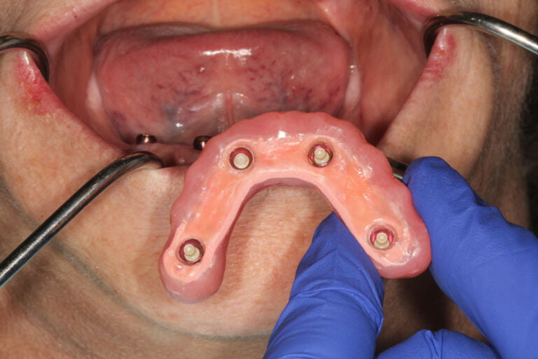 How to Design & Make Affordable Full-Arch Fixed Cases… In Just One Visit!