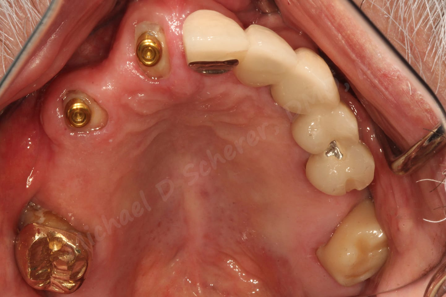 Root Resurgence - LOCATOR Root is Back! - LearnDentistry™