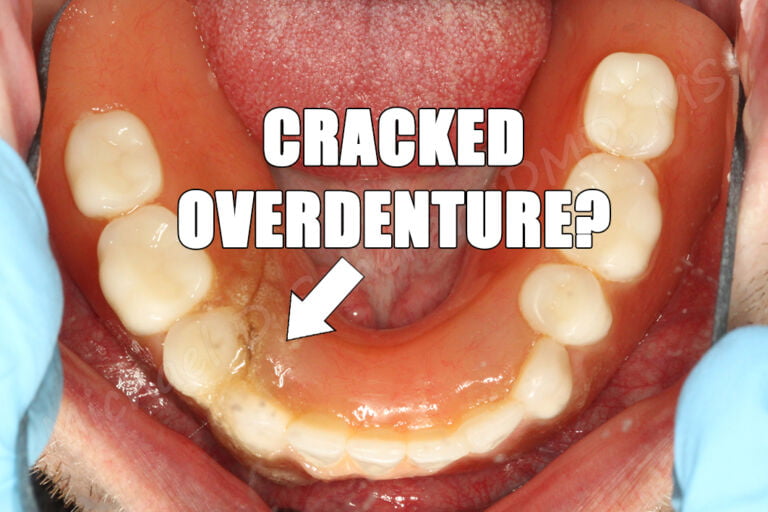 How Much Space in a Denture Do I Need for a LOCATOR? How to Avoid the Cracked Denture