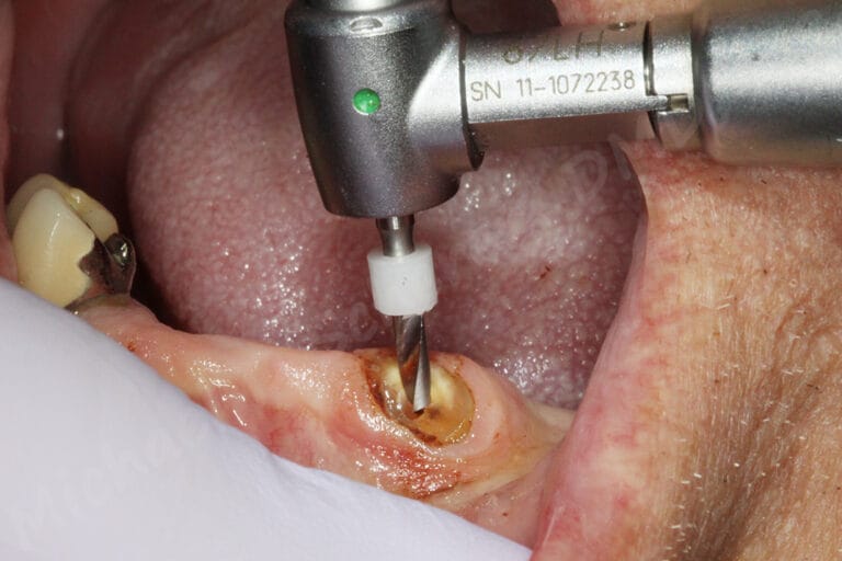 Root Resurgence - LOCATOR Root is Back! - LearnDentistry™