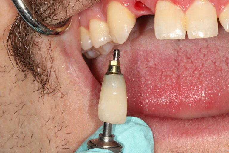 3D Printing Same-Day Permanent Crowns with a Desktop Printer and Helping Out a Patient at the Same Time!